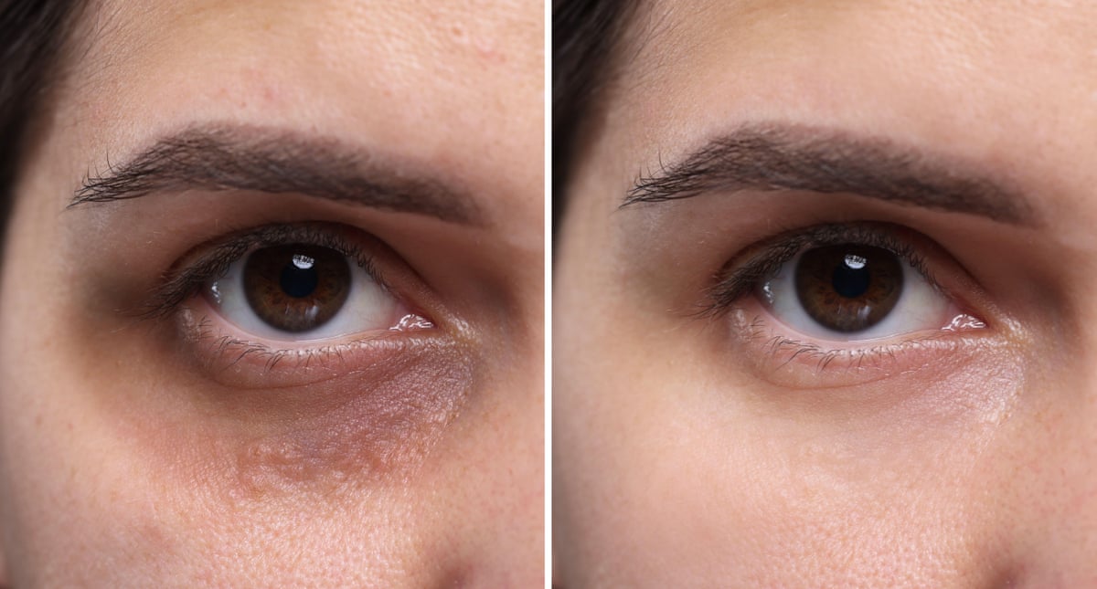 Closeup comparing a dark under-eye bag with another without the bag
