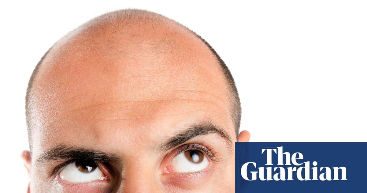 It's painful and expensive but can platelet-rich plasma therapy really cure baldness?