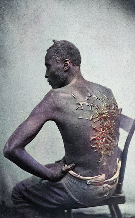Rear View of Former Enslaved Man Revealing Scars at Medical Inspection, 1863