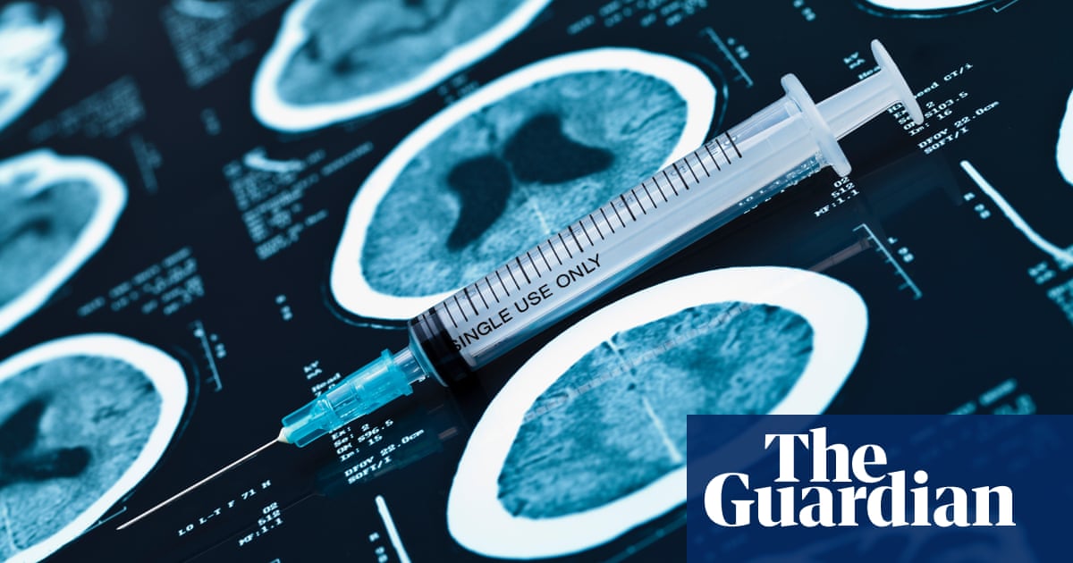 New blood test checks for Alzheimer’s and assesses progression, study says