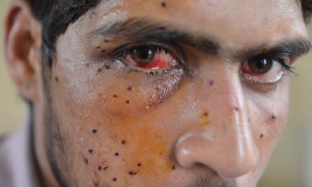 A Kashmiri protester who was shot by Indian security forces in Srinagar, in July 2016.
