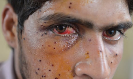 A Kashmiri youth with an eye injury sustained after he was hit by pellets fired by Indian security forces during a protest in Srinagar.