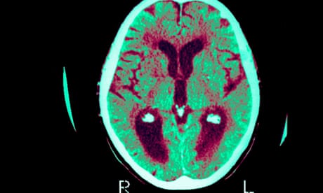 Fracasa la droga para frenar los efectos de la enfermedad de Alzheimer centros para personas mayores residencia para mayores residencias geriatricas precios residencia de tercera edad residencias de ancianos en granada residencias geriatricas lleida residencias de ancianos precios residencias tercera edad precios residencias geriatricas coruña cuidado de ancianos casa hogar para adultos residencias tercera edad malaga residencias geriatricas madrid capital tarifas residencias tercera edad