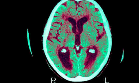 An Alzheimer’s disease scan