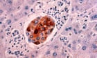 Tiny endo-microscope could spot breast cancer cells forming