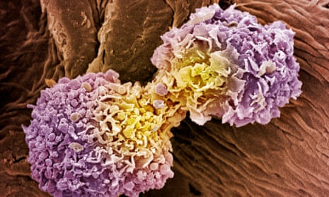 Coloured scanning electron micrograph of dividing breast cancer cells.