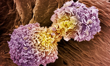 A coloured scanning electron micrograph of dividing breast cancer cells.
