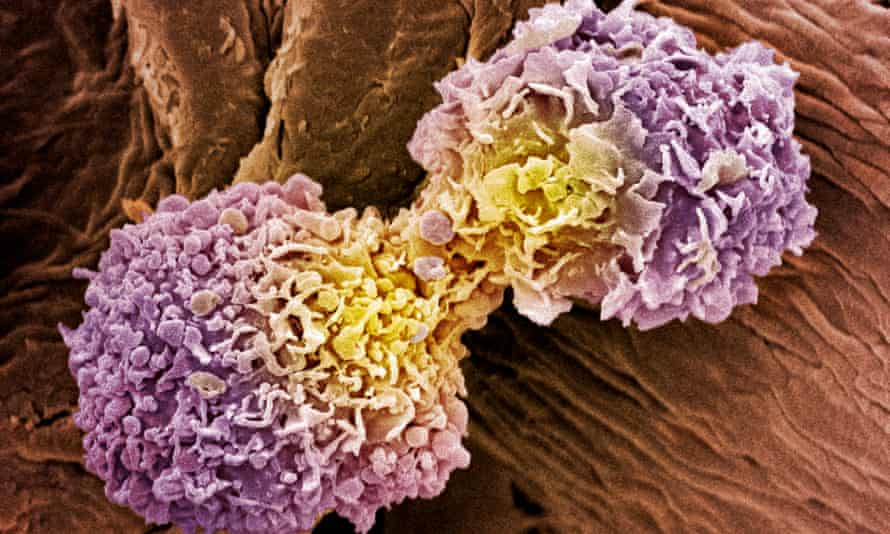 Breast cancer cells shown by a coloured scanning electron micrograph.