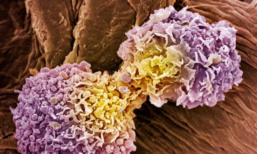 Breast cancer cells: AI-based techniques aim to reduce overdiagnosis and false positives