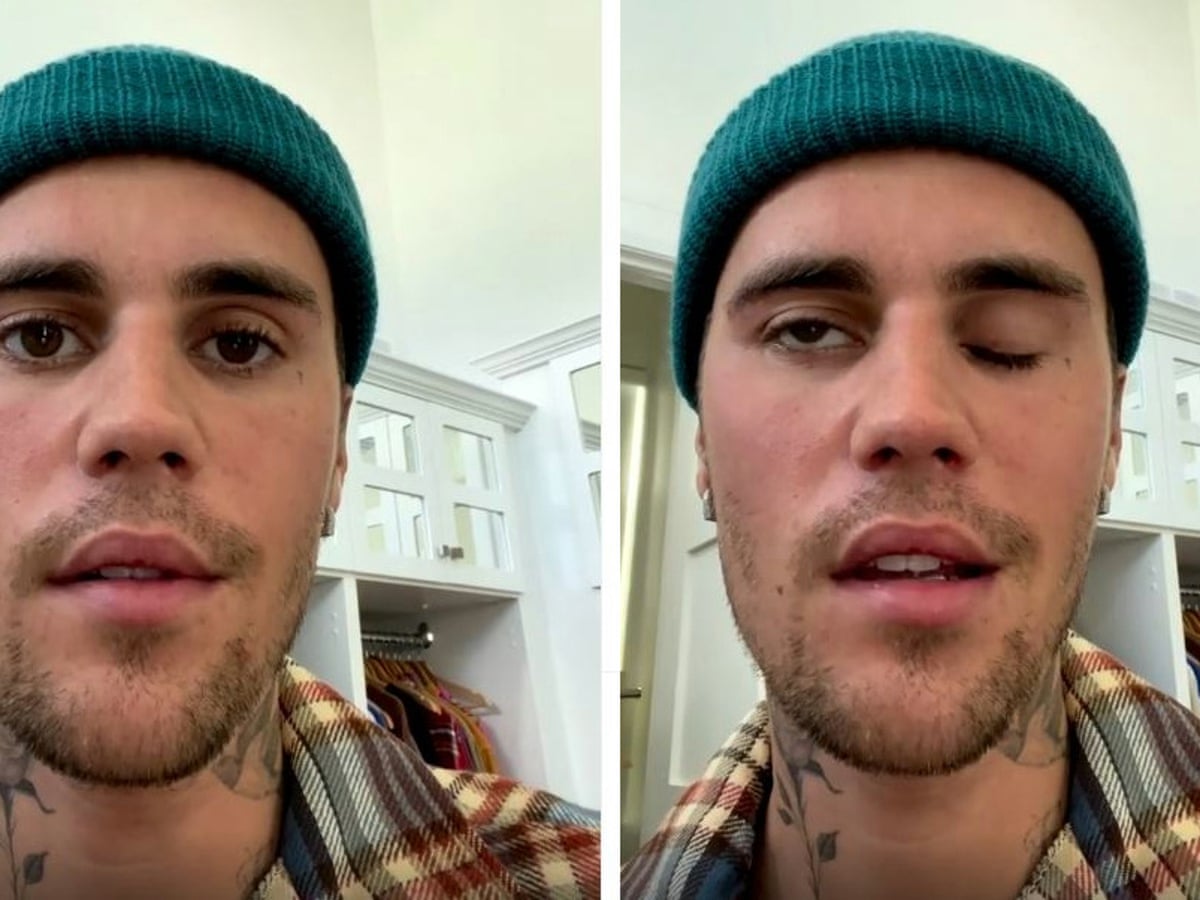 Ramsay Hunt Syndrome Ramsay Hunt Syndrome - Herpes Zoster oticus - Causes - Diagnosis - Best treatment | Homeopathic | Best Homeopathic Doctor in Pakistan | Dr Qaisar Ahmed MD, DHMS