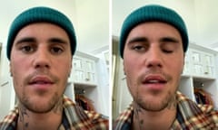 Justin Bieber announces on Instagram that his face is paralysed and that he has Ramsay Hunt syndrome.