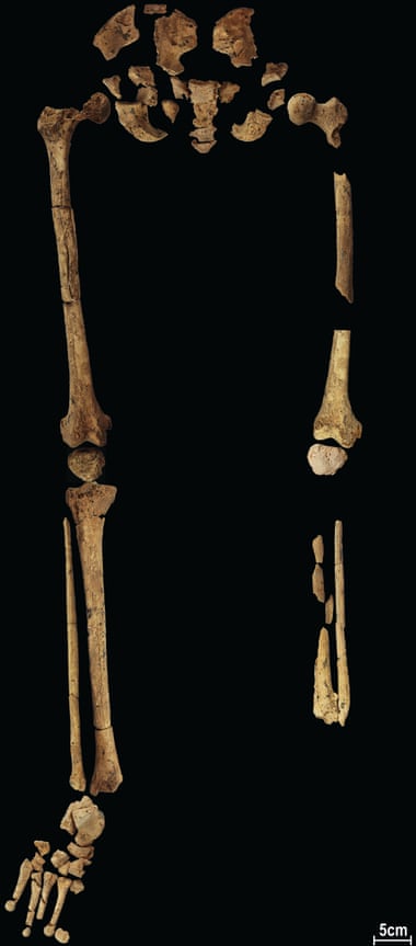 Skeletal remains of a young hunter-gatherer whose lower left leg was amputated by a skilled prehistoric surgeon 31,000 years ago