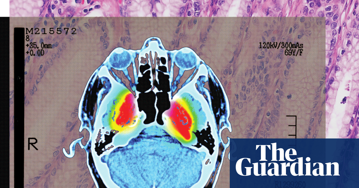 ‘Strong evidence’ of lowered dementia risk: the benefits of shingles vaccination
