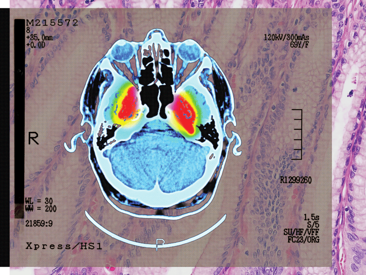 ‘strong Evidence’ of Lowered Dementia Risk: the Benefits of Shingles Vaccination