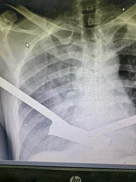 an x-ray shows shrapnel lodged in a body