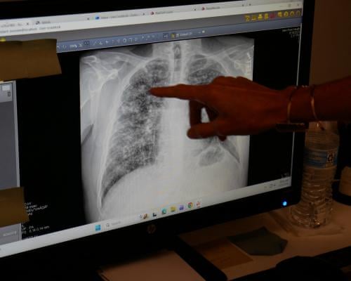 a hand points to a chest xray