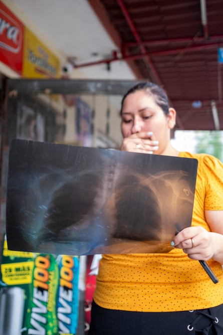 A younger woman holds X-rays of her lungs.