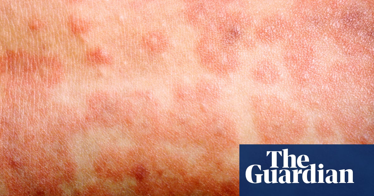 Measles Outbreak Australia 2025