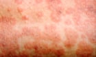 Measles Cases Surge in Europe