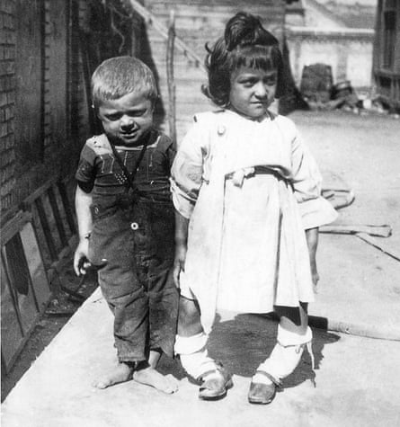 Niños con raquitismo