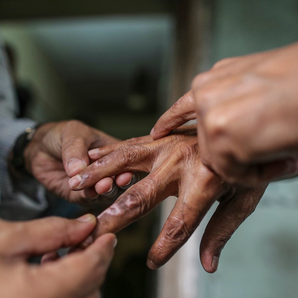 People Affected By Leprosy In India Face Stigma Reinforced By Cruel Colonial Law Global Development The Guardian
