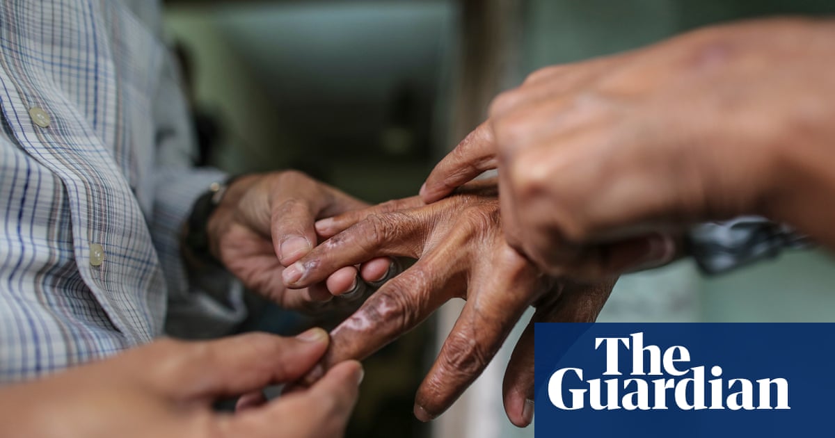People Affected By Leprosy In India Face Stigma Reinforced By Cruel Colonial Law Global Development The Guardian