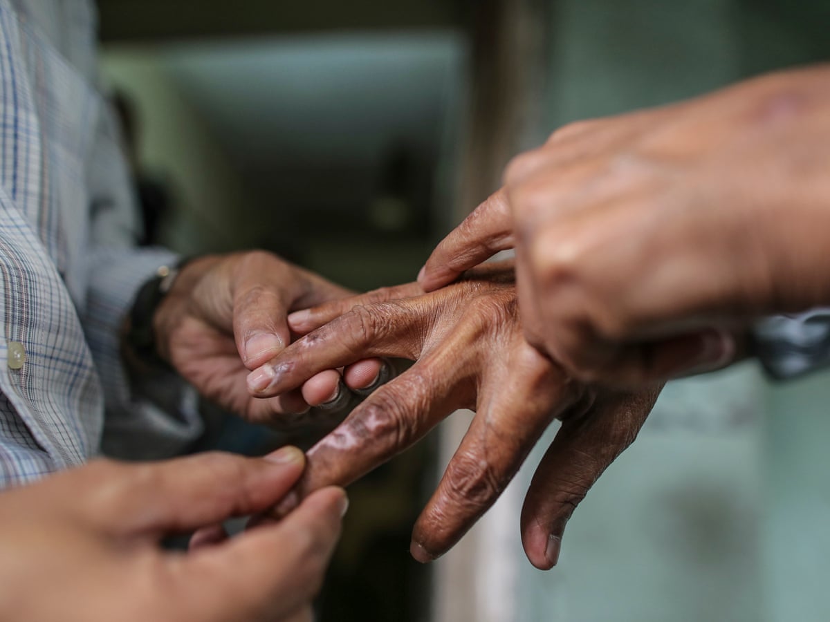 People Affected By Leprosy In India Face Stigma Reinforced By Cruel Colonial Law Global Development The Guardian