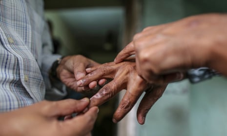 A doctor examines a leprosy patient in Mumbai. More than half of all new leprosy cases each year are diagnosed in India, according to the World Health Organisation.