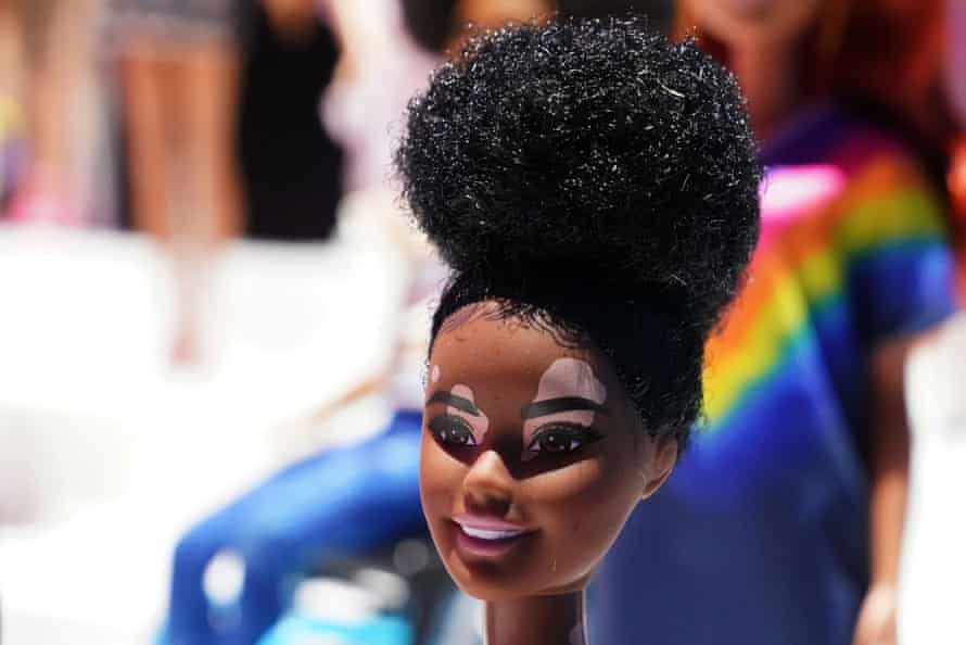 A Barbie doll with vitiligo was released by Mattel in 2020.