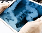 The ick factor that could save a life: US cancer researchers look to fecal waste for treatment clues