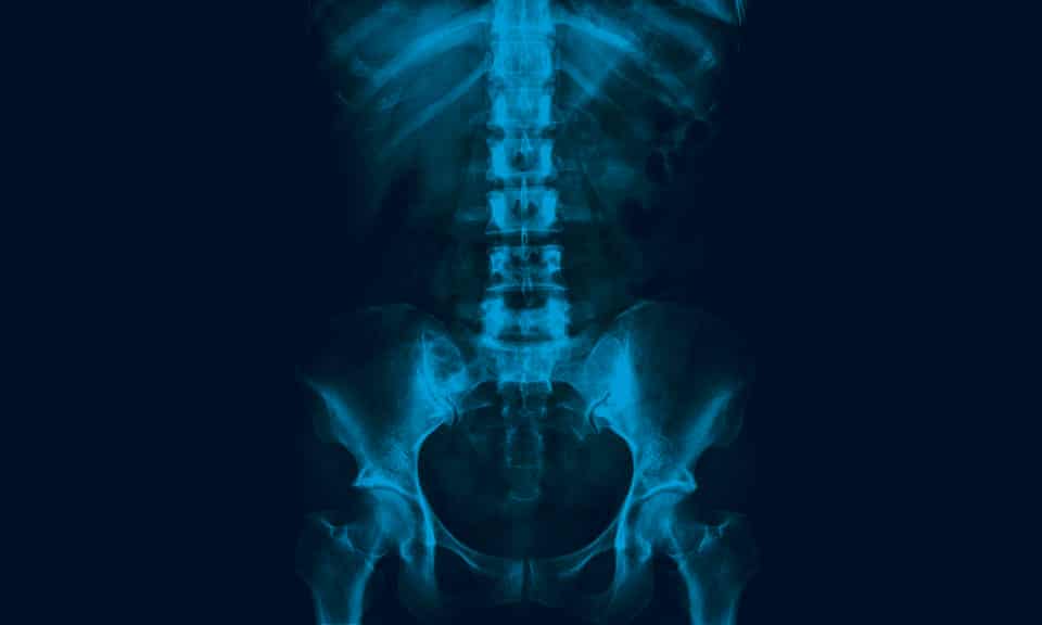 X-ray of the lumbo-sacral spine and pelvis
