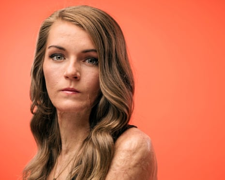 Actress and burn survivor Vicky Knight. Photo by Linda Nylind. 9/5/2019.