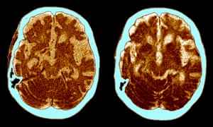 CT scans of a patient with Alzheimer’s disease. If the protein therapy is effective in humans it could be a potent weapon against neurodegenerative diseases such as Alzheimer’s.
