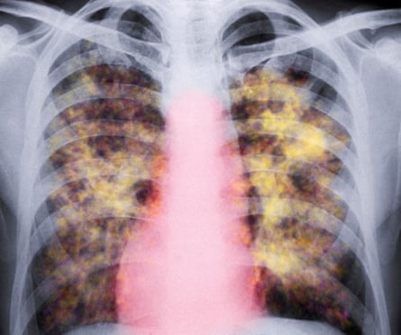 Coloured X-ray of the lungs of a patient with silicosis. The yellow grainy masses in the lungs are areas of scarred tissue and inflammation.