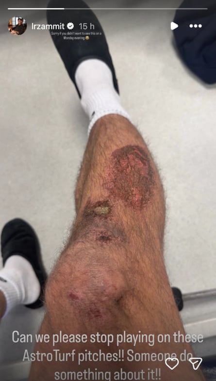 Louis Rees-Zammit's burn injuries to his right leg