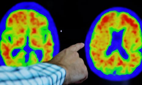 Positron emission tomography (PET) scans at the Center for Alzheimer Research and Treatment in Boston, US.