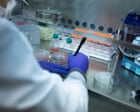 Only 3% of US sickle cell patients receive red blood cell exchange for disease, researchers find