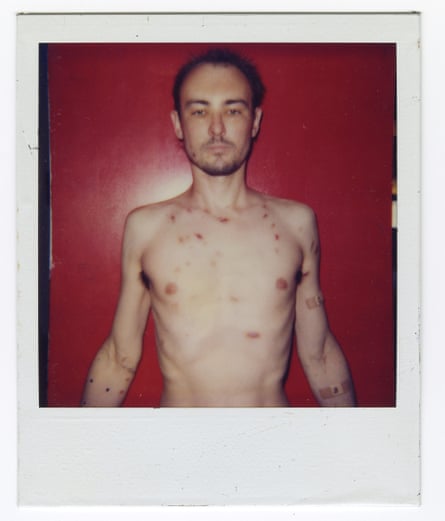 A Polaroid of Gordon Stevenson, showing his Kaposi’s sarcoma lesions.
