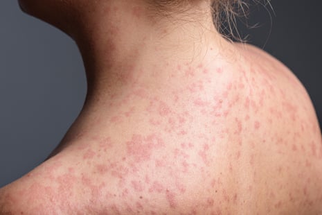 Close-up of a woman's neck, shoulders and upper back covered in a red, blotchy measles rash