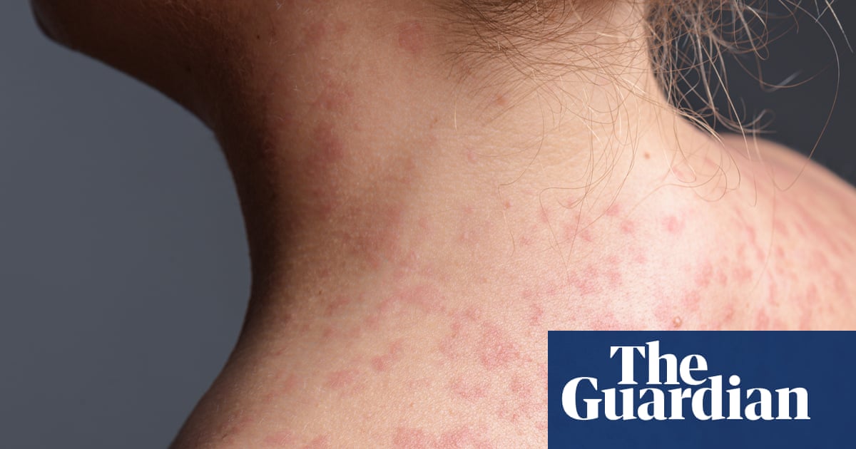 Rise in holiday measles infections sparks health alerts in NSW, SA and Victoria | Health Rise in holiday measles infections sparks health alerts in NSW, SA and Victoria | Health