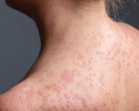 A person with a measles rash across their neck, shoulders and back.