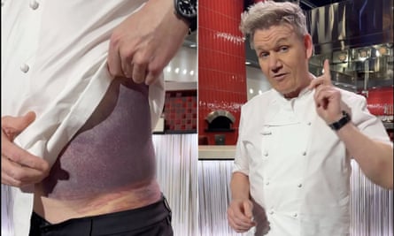 Composite from Gordon Ramsay’s social media feeds showing him looking at the camera as well as him lifting his shirt to show a large bruise