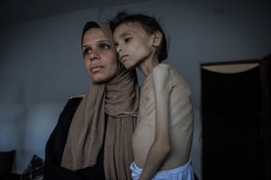 An emaciated child pictured with her mother