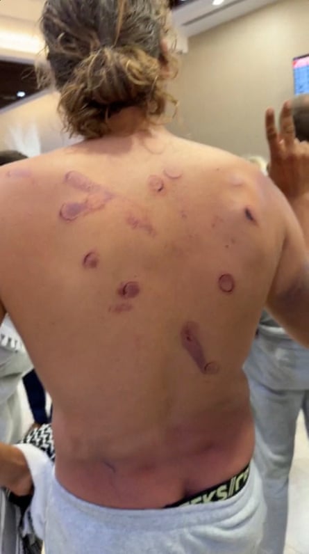 Adrien Jouan showing injuries on his back