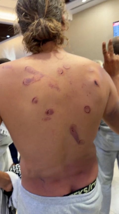 Adrien Jouan showing injuries on his back