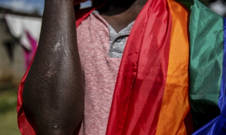 A gay Ugandan shows the scars he suffered in an attack in May, outside the house he shares with other LGBT+ people in Nairobi, Kenya.