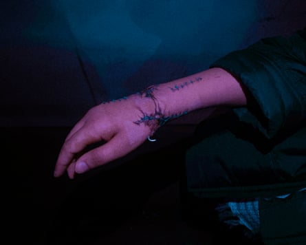 A woman’s hand and wrist showing stitches in several areas after sustaining a bullet wound