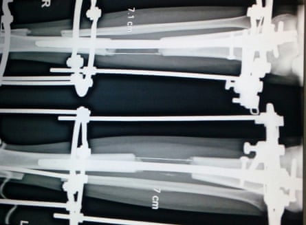 An x-ray showing the progress of limb lengthening surgery in India.