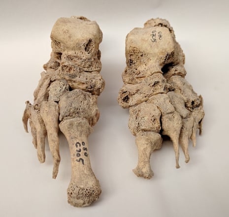 Skeletal remains showing evidence of leprosy from the Odense St. Jørgen cemetery in Denmark,which was established in 1270 and existed until 1560.