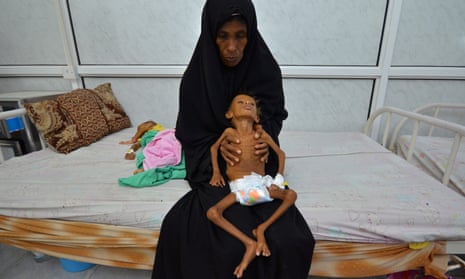 A mother holds her six-year-old son at a hospital in the Red Sea port city of Hodeida.